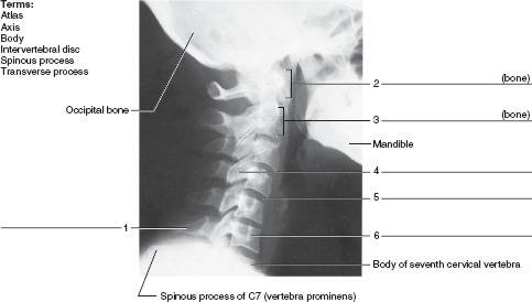 Identify the bones and features indicated in this radiograph of the neck