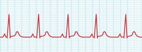 Use the normal ecg trace below to determine how many seconds the trace represents as well as the hea