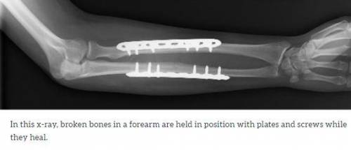 Which type of fixation of a fracture usually is not removed after the fracture has healed?