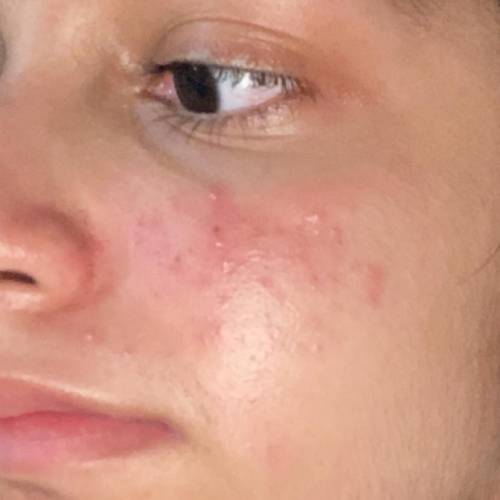 Skincare

I have this on my for more than 4 months ig. It’s not improving. Can anybody tell me wha