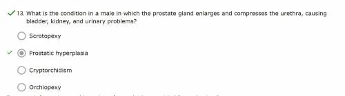 What is the condition in a male in which the prostate gland enlarges and compresses the urethra, ca